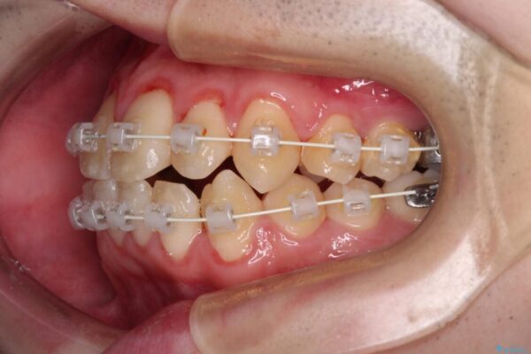 全顎的なクロスバイト　補助装置を用いてワイヤー矯正 治療途中画像