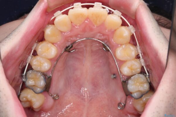 全顎的なクロスバイト　補助装置を用いてワイヤー矯正 治療途中画像