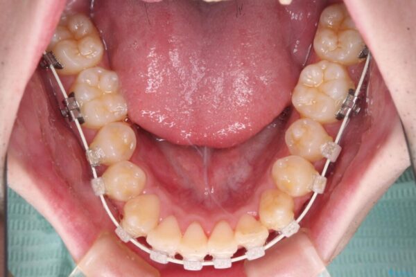 全顎的なクロスバイト　補助装置を用いてワイヤー矯正 治療途中画像