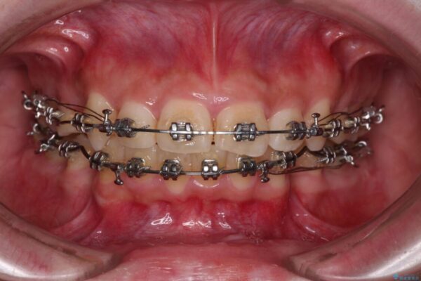 下顎前歯が隠れて突出した口元　ワイヤー装置での抜歯矯正 治療途中画像