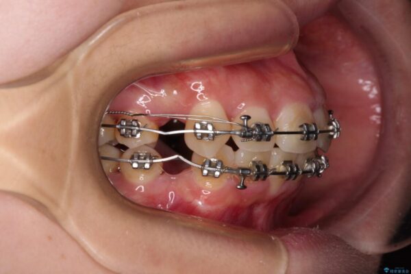 下顎前歯が隠れて突出した口元　ワイヤー装置での抜歯矯正 治療途中画像