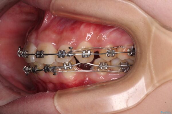 下顎前歯が隠れて突出した口元　ワイヤー装置での抜歯矯正 治療途中画像