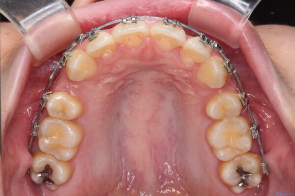 下顎前歯が隠れて突出した口元　ワイヤー装置での抜歯矯正 治療途中画像