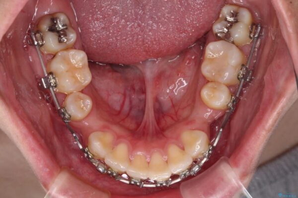 下顎前歯が隠れて突出した口元　ワイヤー装置での抜歯矯正 治療途中画像