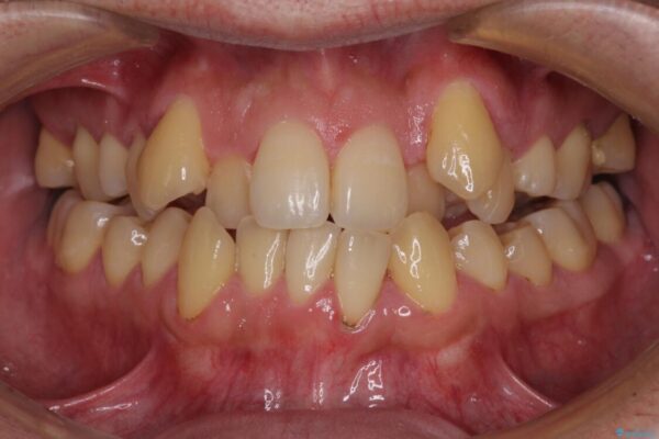 八重歯とクロスバイト　目立たないワイヤー装置で矯正治療 ビフォー