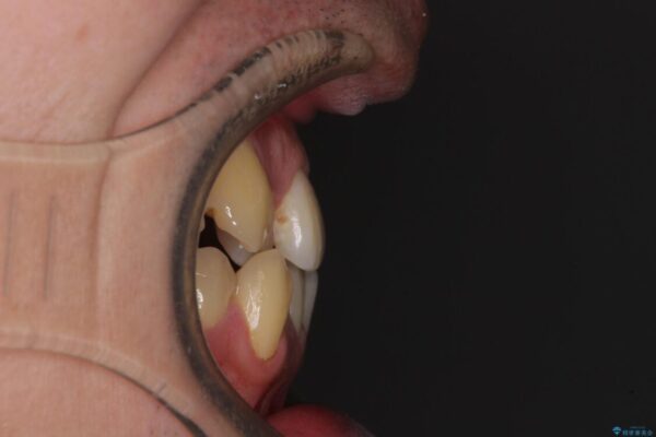 八重歯とクロスバイト　目立たないワイヤー装置で矯正治療 治療前画像