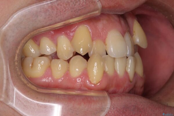 八重歯とクロスバイト　目立たないワイヤー装置で矯正治療 治療前画像