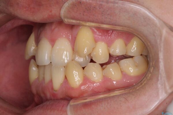 八重歯とクロスバイト　目立たないワイヤー装置で矯正治療 治療前画像