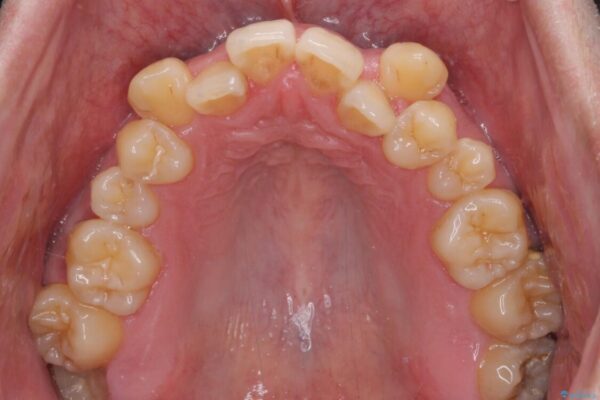八重歯とクロスバイト　目立たないワイヤー装置で矯正治療 治療前画像