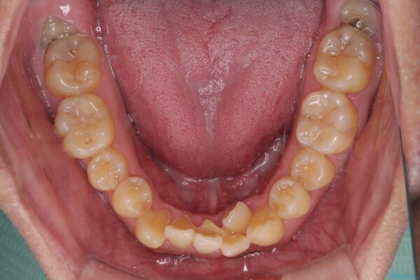 八重歯とクロスバイト　目立たないワイヤー装置で矯正治療 治療前画像