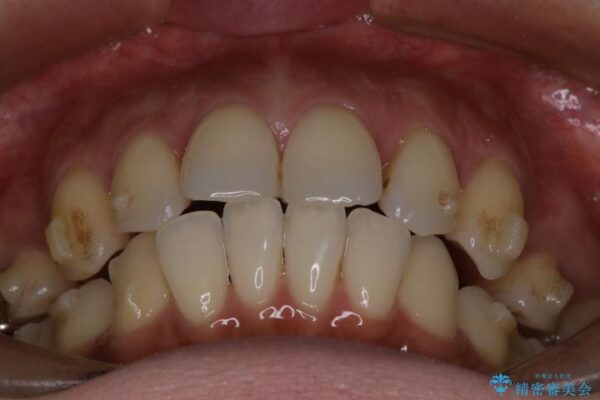 上顎前歯の突出を軽減　インビザラインによる抜歯矯正 治療途中画像