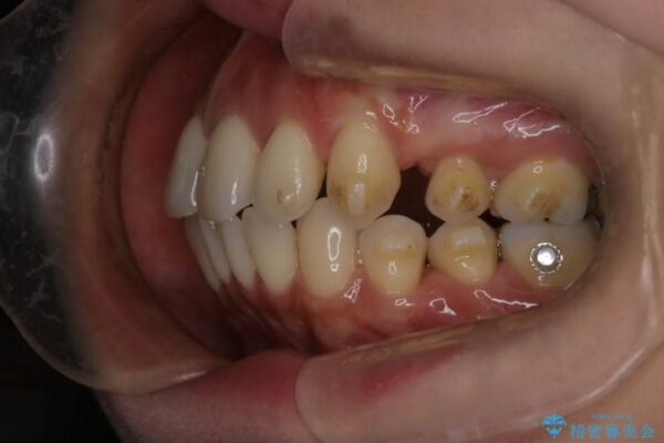 上顎前歯の突出を軽減　インビザラインによる抜歯矯正 治療途中画像