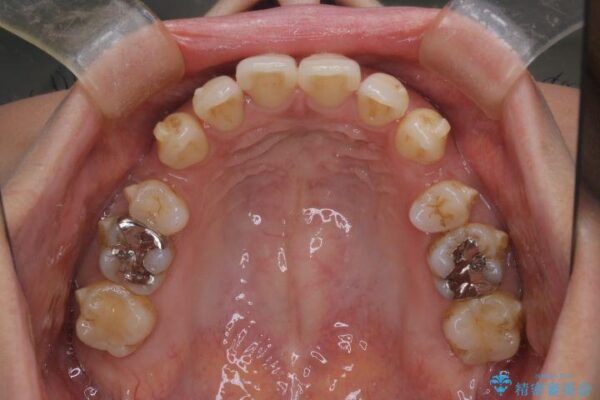 上顎前歯の突出を軽減　インビザラインによる抜歯矯正 治療途中画像