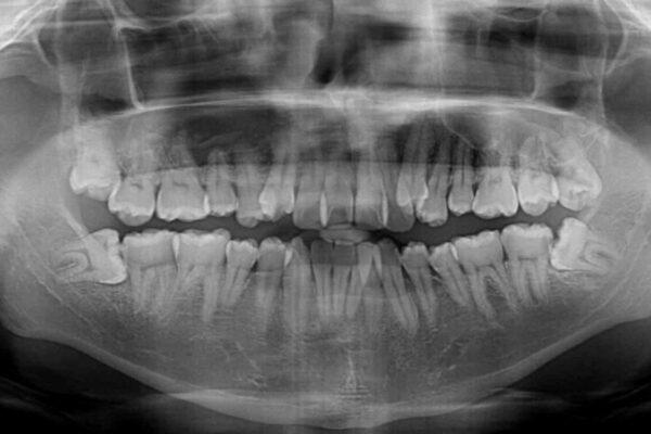 八重歯とクロスバイト　目立たないワイヤー装置で矯正治療 治療前画像