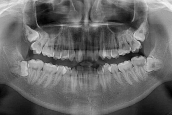 全顎的なクロスバイト　補助装置を用いてワイヤー矯正 治療前画像