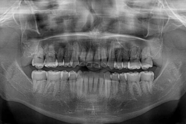 八重歯とクロスバイト　目立たないワイヤー装置で矯正治療 治療後画像