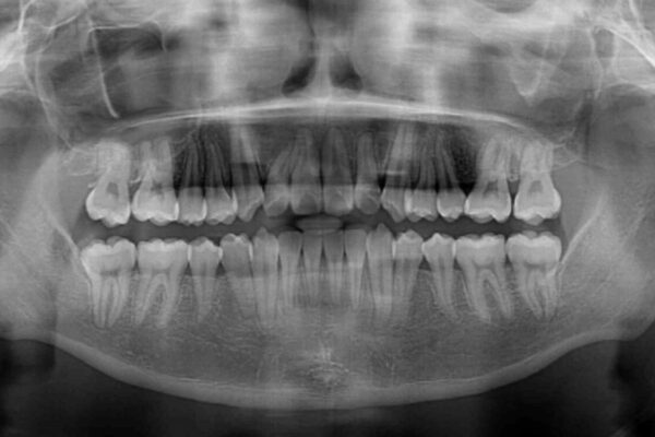 全顎的なクロスバイト　補助装置を用いてワイヤー矯正 治療後画像