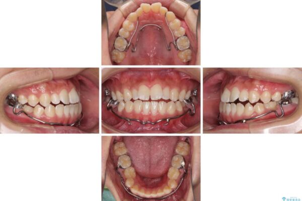 口元の突出感を改善　受け口傾向の咬み合わせの抜歯矯正 治療途中画像