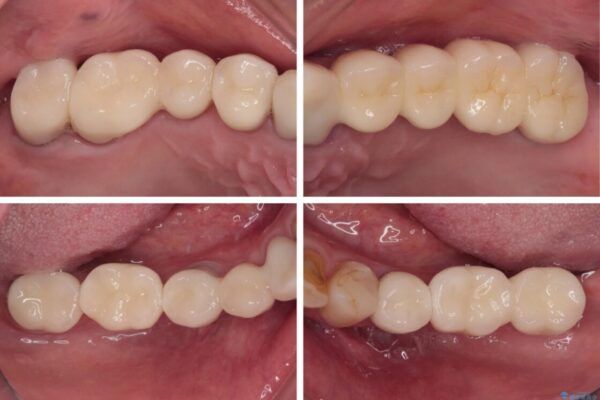 放置したインプラントとインビザライン　全顎リカバリー治療 治療後画像