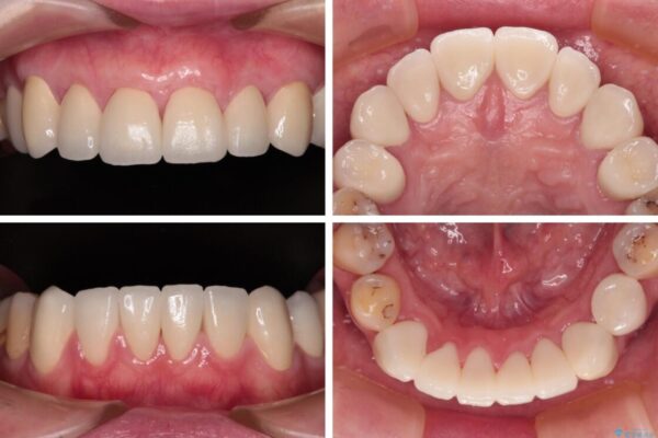 むし歯だらけの前歯をオールセラミッククラウンできれいに 治療後画像