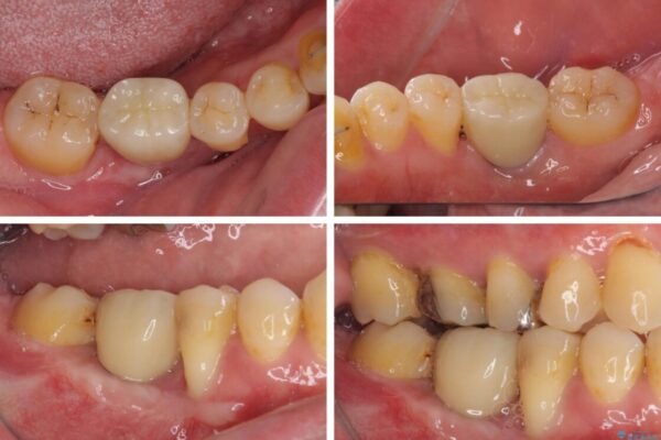 割れてしまった奥歯とデコボコの前歯　矯正治療とインプラント治療 治療後画像