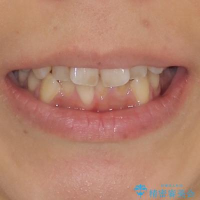 デコボコと口元の突出感　ハーフリンガルでの抜歯矯正 治療前