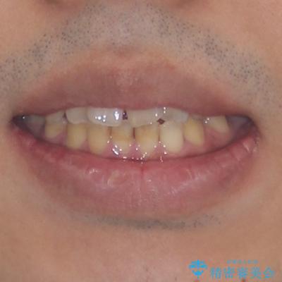 後戻りでデコボコの前歯　インビザライン矯正治療 ビフォー