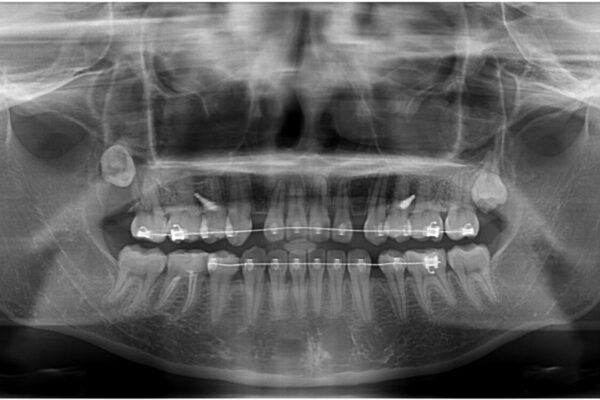 転勤でも安心して治療継続　抜歯スペース閉鎖と深い噛み合わせ改善のワイヤー矯正 治療前画像