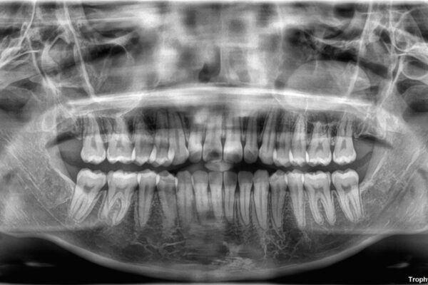 目立ちにくい表側装置で1年完了!狭いアーチを側方拡大し前歯のデコボコを整えた症例 治療後画像