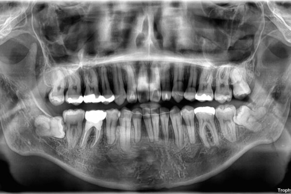 口元の突出感を改善!目立ちにくいワイヤー矯正で自信を持てる自然な横顔に 治療後画像