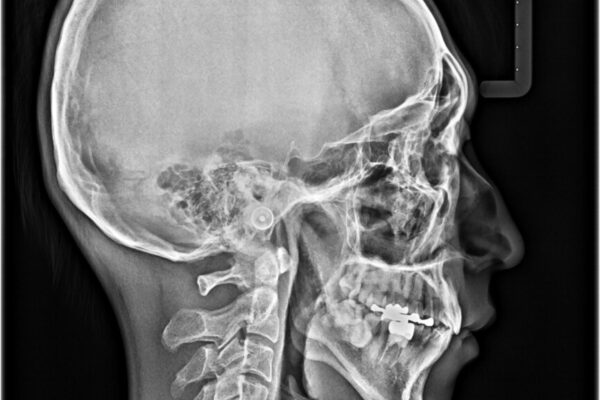 口元の突出感を改善!目立ちにくいワイヤー矯正で自信を持てる自然な横顔に 治療後画像