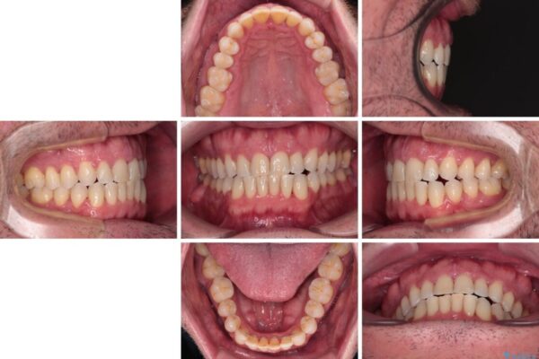 前歯でものを噛みきりたい　目立たない装置でのワイヤー矯正 治療後画像