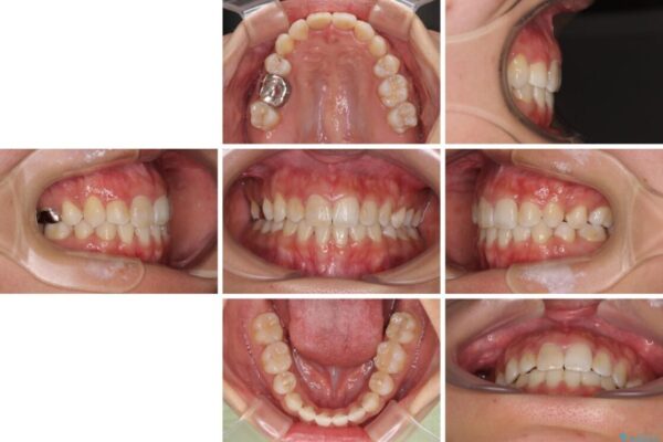 気になる八重歯　目立ちにくいハーフリンガルでの抜歯矯正 治療後画像