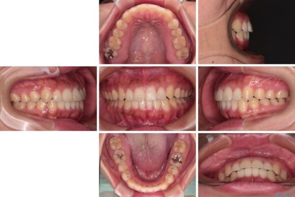 【モニター】カリエール・ディスタライザーを併用した八重歯のインビザライン矯正 治療後画像