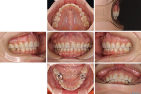 【モニター】出っ歯と咬み合わせを改善　ワイヤー装置の抜歯矯正 治療後画像