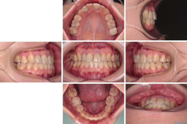 虫歯治療ついでに歯並びの後戻りを改善　インビザラインによる矯正治療 治療後画像