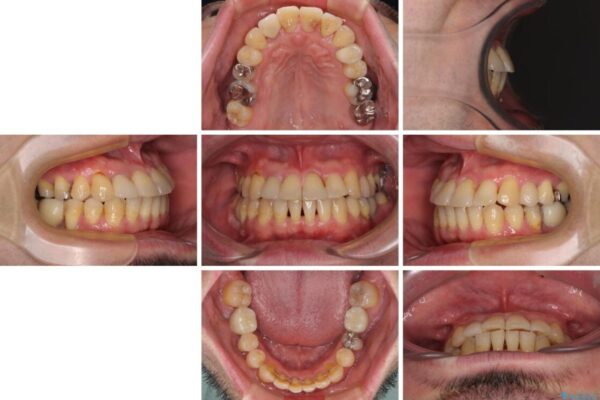 割れてしまった奥歯とデコボコの前歯　矯正治療とインプラント治療 治療後画像