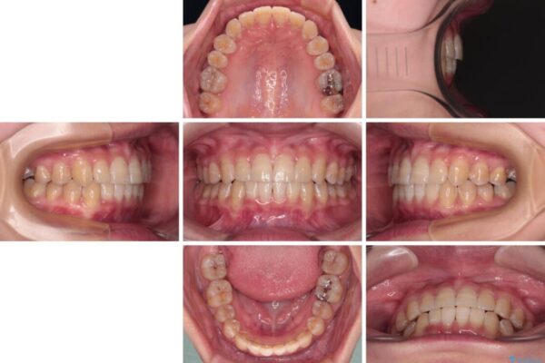 【モニター】下顎前歯のデコボコをインビザラインできれいに 治療後画像