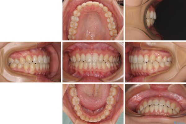 隙間だらけの歯列　インビザラインで改善 治療後画像