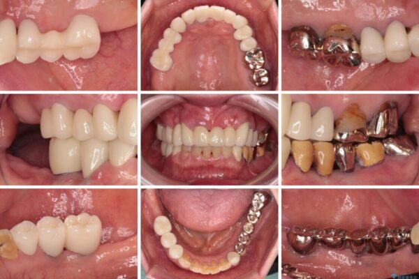 前歯をきれいにしたい　インプラントや部分矯正を用いた総合歯科治療 治療後画像