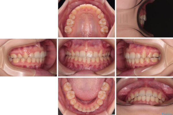 【モニター】口が閉じられない　ワイヤー装置での抜歯矯正 治療後画像