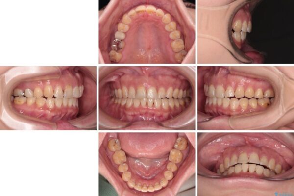 【モニター】飛び出た前歯を整えたい　ワイヤー矯正治療 治療後画像