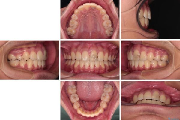 膨らんだ口元　ワイヤー装置での抜歯矯正 治療後画像