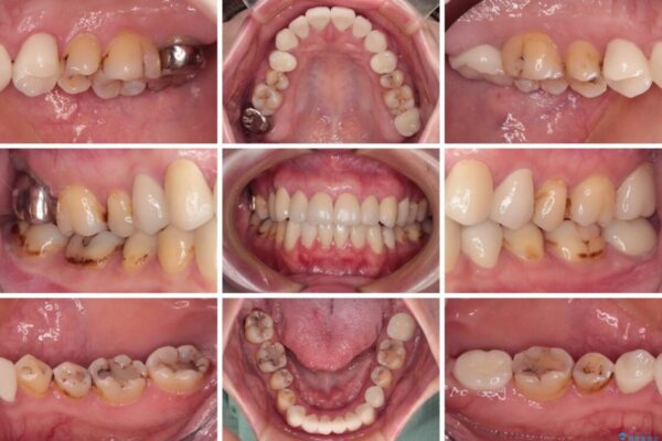 むし歯だらけの前歯をオールセラミッククラウンできれいに 治療後画像