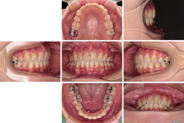 デコボコと深い咬み合わせ　ワイヤー装置での抜歯矯正 治療後画像