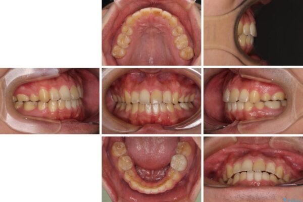 後戻りでデコボコの前歯　インビザライン矯正治療 治療後画像