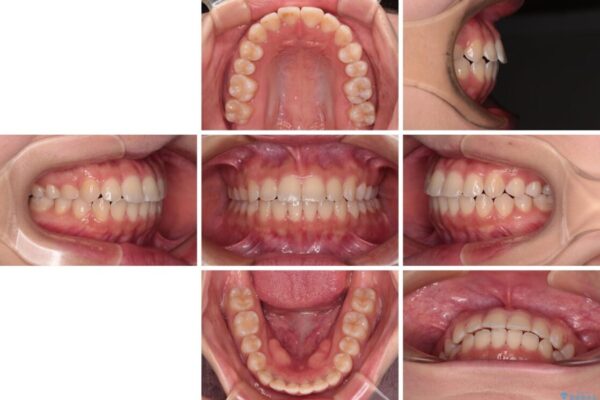 【モニター】短期間で終わりたい　ワイヤー装置での非抜歯矯正 治療後画像