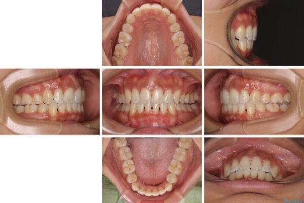 抜歯矯正で唇を閉じやすく　目立たないワイヤー装置 治療後画像