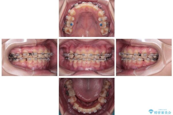 転勤でも安心して治療継続　抜歯スペース閉鎖と深い噛み合わせ改善のワイヤー矯正 治療途中画像