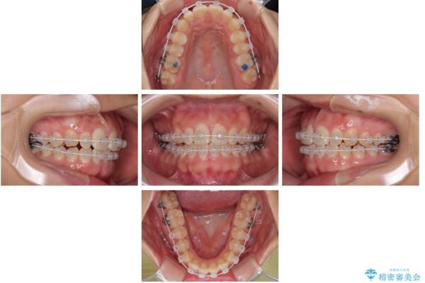 目立ちにくい表側装置で1年完了!狭いアーチを側方拡大し前歯のデコボコを整えた症例 治療途中画像